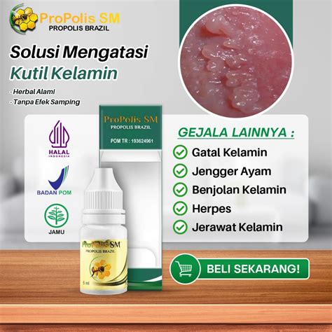Jual Propolis SM Obat Herbal Kutil Kelamin HPV Jengger Ayam Kondiloma ...