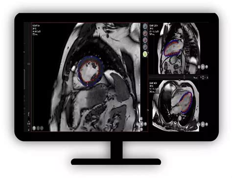 Philips - MR Caas Strain Quantify myocardial strain