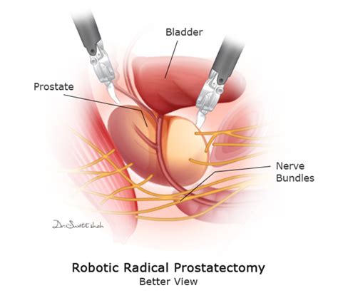 Robotic Prostate Surgery Procedure 的图像结果