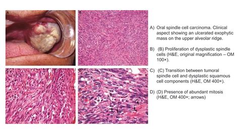 Histopathological variants of squamous cell carcinoma (Doctor Faris Alabeedi MSc, MMedSc, PgDip ...