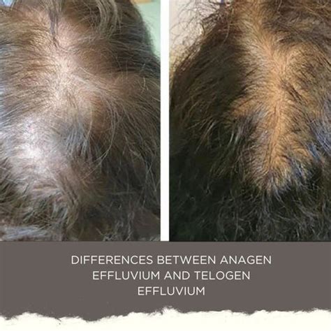 Understanding Anagen Effluvium and Treatment Options | Clinikally