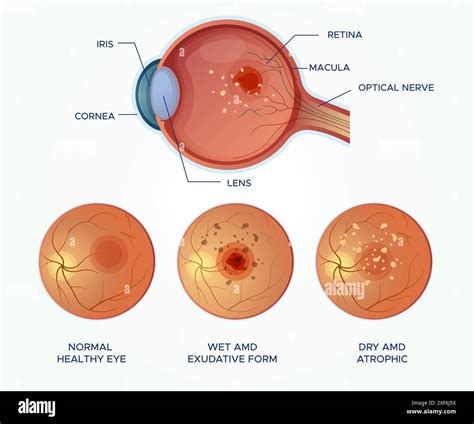 Wet Amd Vs Dry Amd
