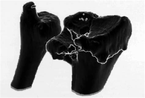 Image result for Open Reduction Distal Radius Fracture