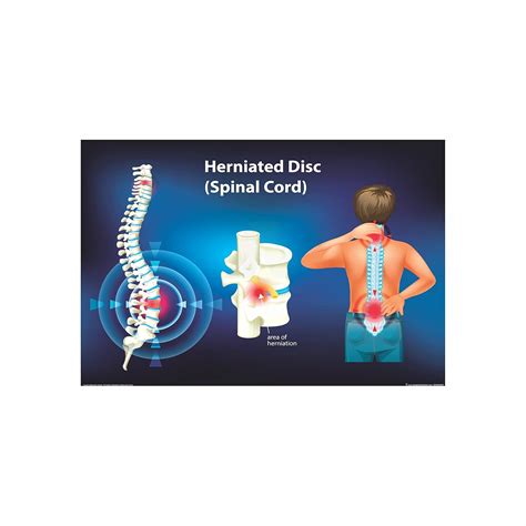 Anne Print Solutions® Herniated disc spinal cord Posters For Hospital ...