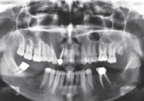 Odontogenic keratocyst, definition, causes, symptoms, diagnosis, treatment & prognosis