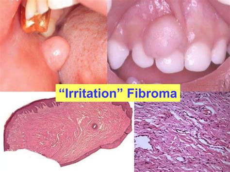 Lesions of oral cavity and salivary gland. | PPTX