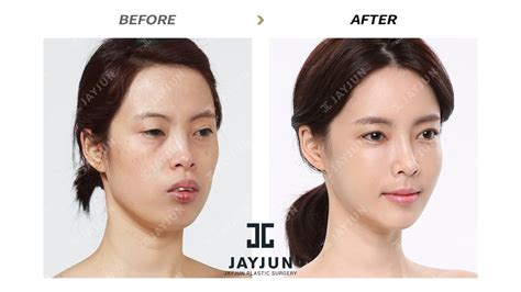 korean plastic surgery korea cosmetic surgery korean plastic surgery before and after cosmetic ...