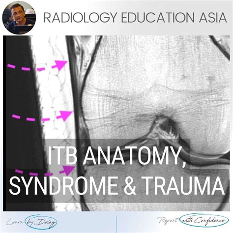 ILIOTIBIAL BAND MRI ANATOMY, SYNDROME, TRAUMA KNEE RADIOLOGY - Radedasia