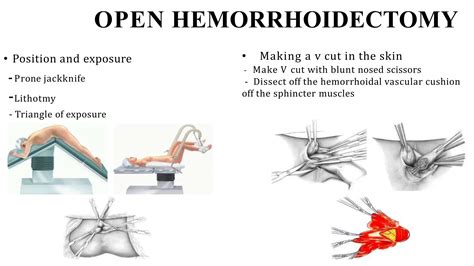 Hemorrhoidectomy surgical procedure RAF.pptx