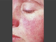 Image result for lupus%20erythematosus