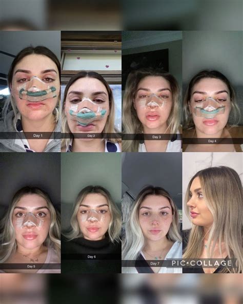 Rhinoplasty Recovery
