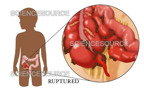 Image result for Appendix Exploded