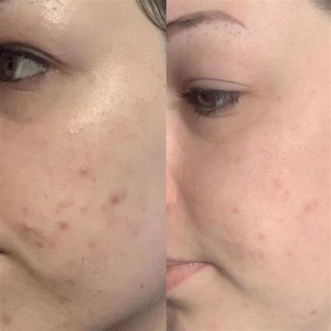 LAURITZ 10% Lactic Acid Instant Glow & Radiance Serum