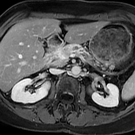 Pancreatic adenocarcinoma - Body MR Radiology Case Studies - CTisus CT ...