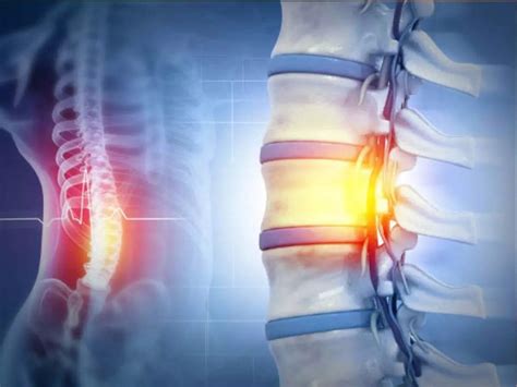 He is just 32. No accident, no gym but spine damaged. AIIMS orthopaedic ...