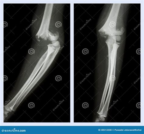 Fracture Elbow (Left Image : Side Position , Right Image : Front Position) Stock Photo - Image ...
