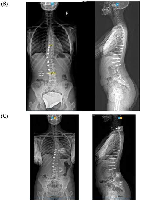 Posterior Vertebral Pedicular Tethering for the Treatment of Idiopathic ...