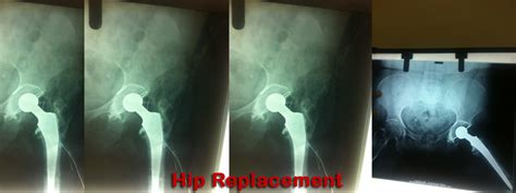 Dr.R.K.Verma | Joint Replacement in Jaipur | Joint Replacement Surgeons ...