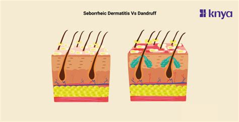 Scalp Flakes: Seborrheic Dermatitis vs. Dandruff – Knya