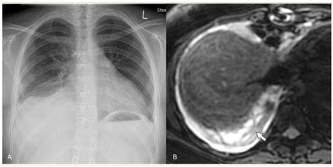 Imaging of Acute Complications of Community-Acquired Pneumonia in the ...