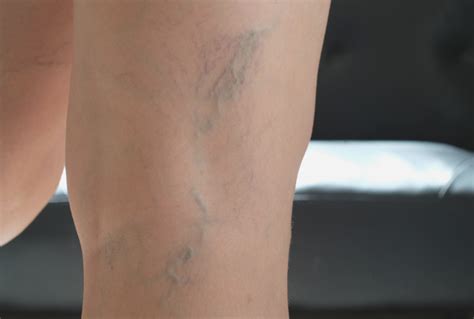 Varicose veins during pregnancy: Risk factors, how to treat this common ...