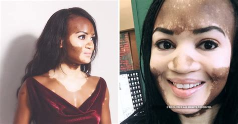 A model revealed her rare skin condition in a moving post about self ...