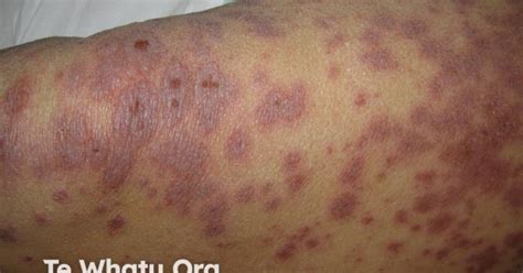 Rash Pictures SJS 的图像结果