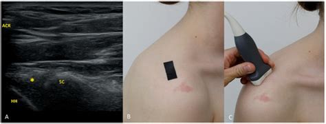 Clock-Face Sonography of the Glenoid Labrum: A Pictorial Technical ...