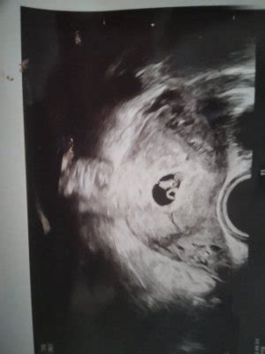 Ecografia 6+4 metodo Ramzi | BabyCenter