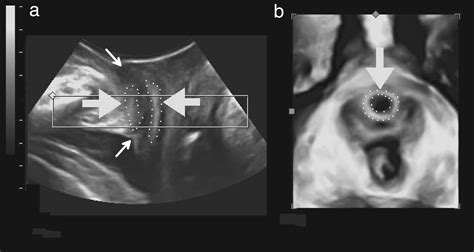 Urethral Diverticula Radiology Key