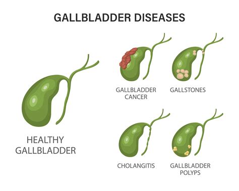 Gallbladder Disease: Risks and Symptoms | Dr Manju