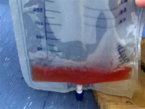 小小针孔解决大问题——肝脓肿的微创治疗-长江航运总医院
