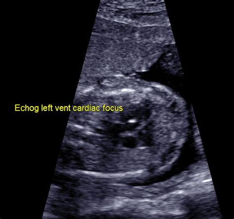 Isolated ‘soft signs’ of fetal choroid plexus cysts or echogenic intracardiac focus ...