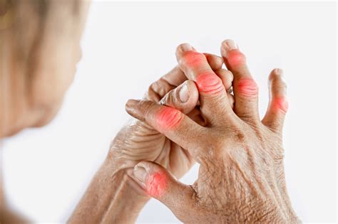 Asian Woman Hand Suffering From Joint Pain With Gout In Finger Stock ...