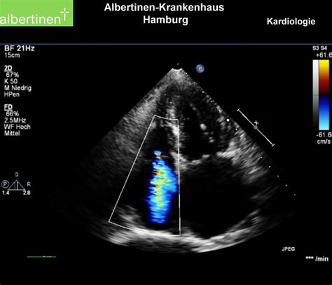 Tricuspid Valve Insufficiency - DocCheck