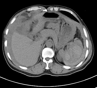【病例】外伤性脾破裂1例CT影像表现 – 影像PPT