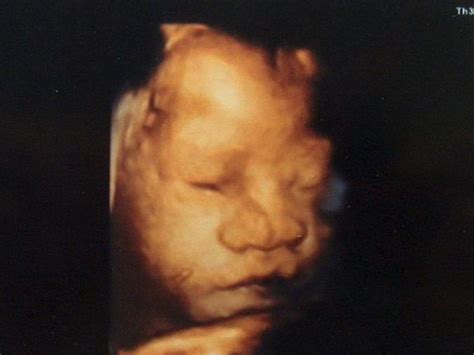 怀孕33周B超显示胎儿双顶径偏小两周正常吗?_家庭医生在线