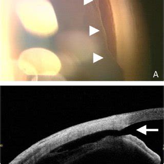 Angle Recession 的图像结果