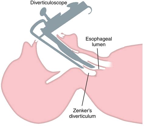 Diverticula of the Pharynx, Esophagus, Stomach, and Small Intestine - Clinical Tree