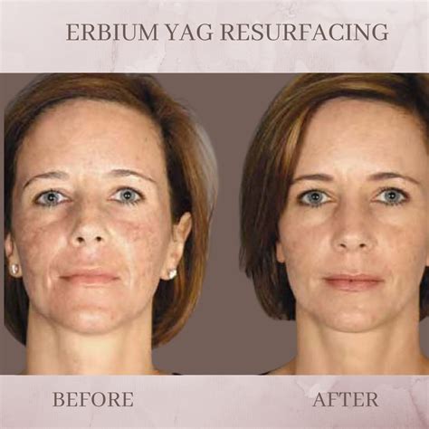 Erbium Skin Resurfacing - Eluma - Laser & Aesthetics