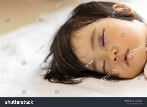 Eye Bleeding Baby at Phyllis Fetter blog