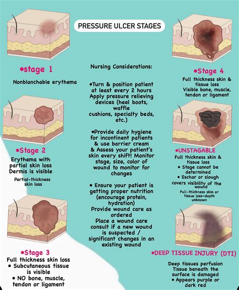 Pressure Ulcer Stage 1,2,3,4