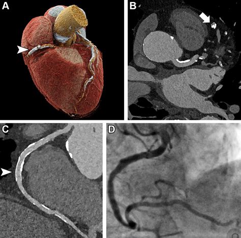 Accuracy of Ultrahigh-Resolution Photon-counting CT for Detecting Coronary Artery Disease in a ...