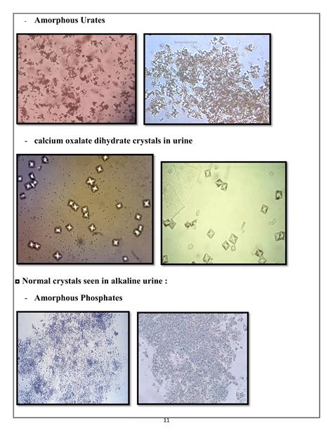 Amorphous Crystals In Human Urine at Carole Spears blog