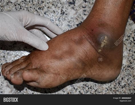 Pitting Edema Lower Image & Photo (Free Trial) | Bigstock