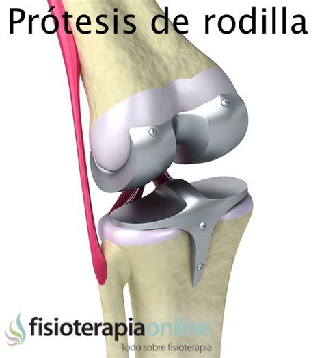 Todo lo que debemos saber sobre las prótesis de rodilla | FisioOnline