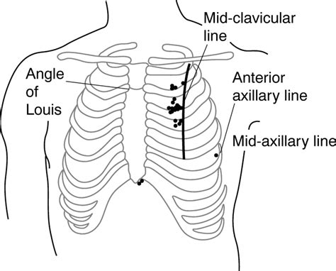 Midclavicular Line