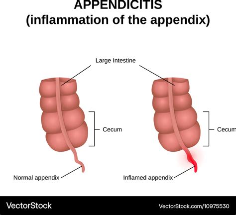 Image result for Appendix Example Website