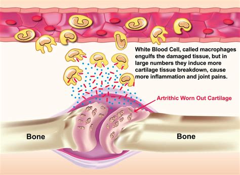 Image result for hormones affecting inflammation in joints