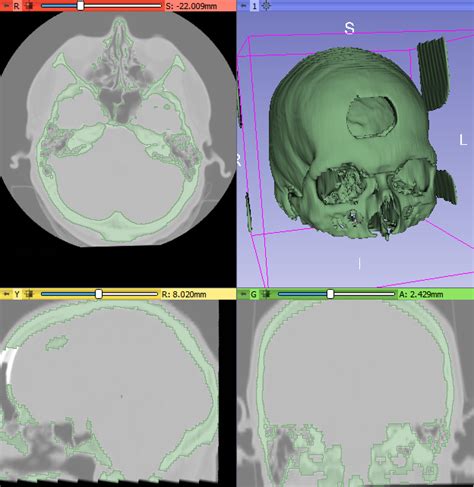 Image result for 3D Slicer Segmentation Tutorial